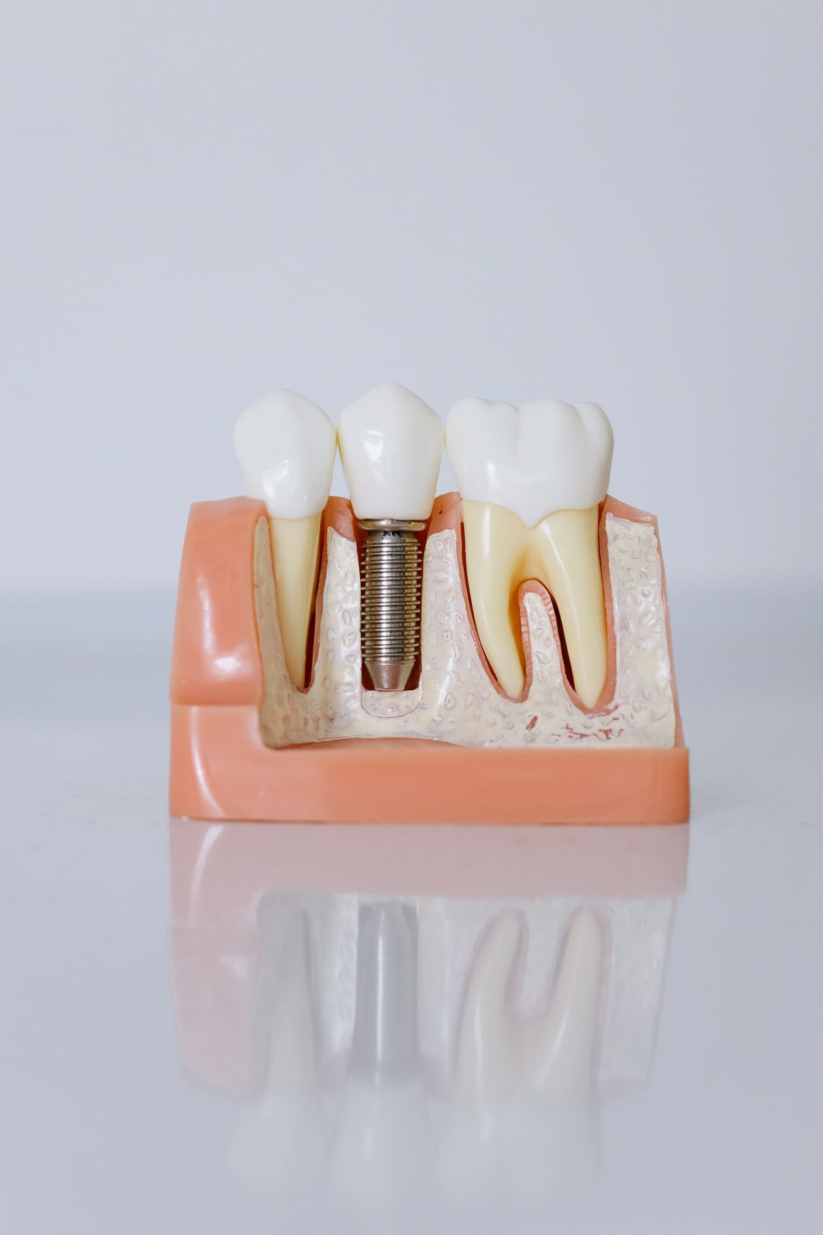 Tooth Implants